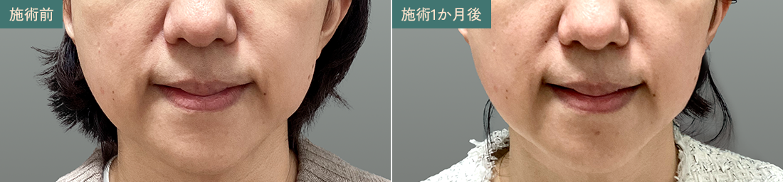 フェイスラインのたるみ 施術前/施術1か月後