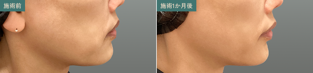 口元のたるみ 施術前/施術1か月後