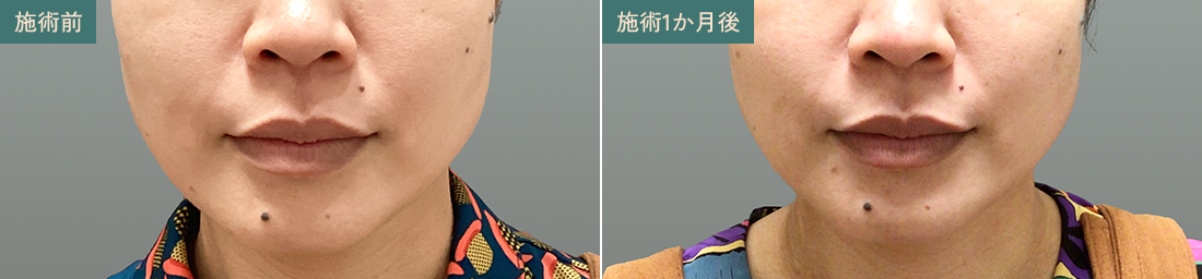 フェイスライン・頬のたるみ 施術前/施術1か月後