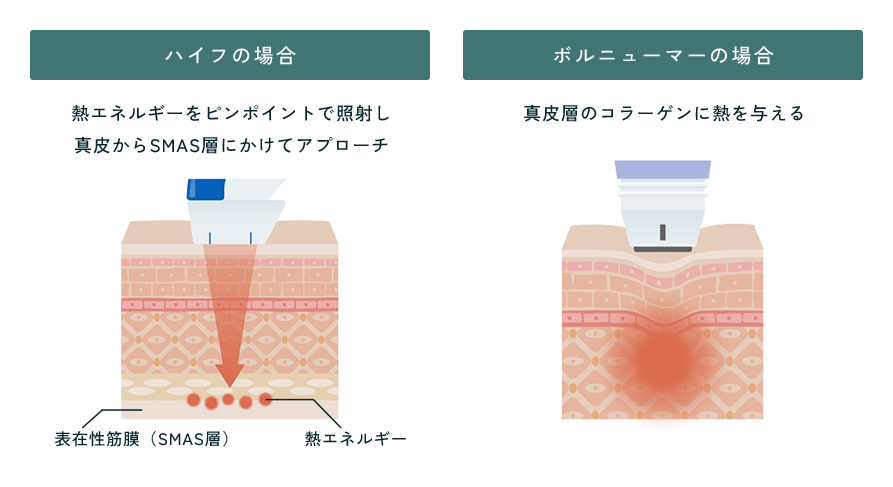 ハイフの場合 熱エネルギーをピンポイントで照射し真皮からSMAS層にかけてアプローチ/ボルニューマーの場合 真皮層のコラーゲンに熱を与える
