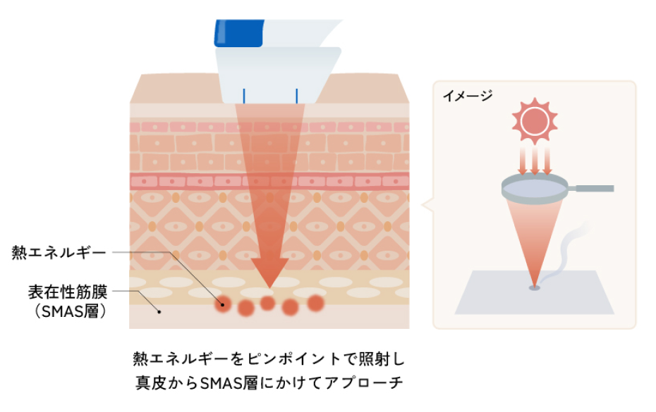 肌の深部から引き上げることで、美しいフェイスラインへ