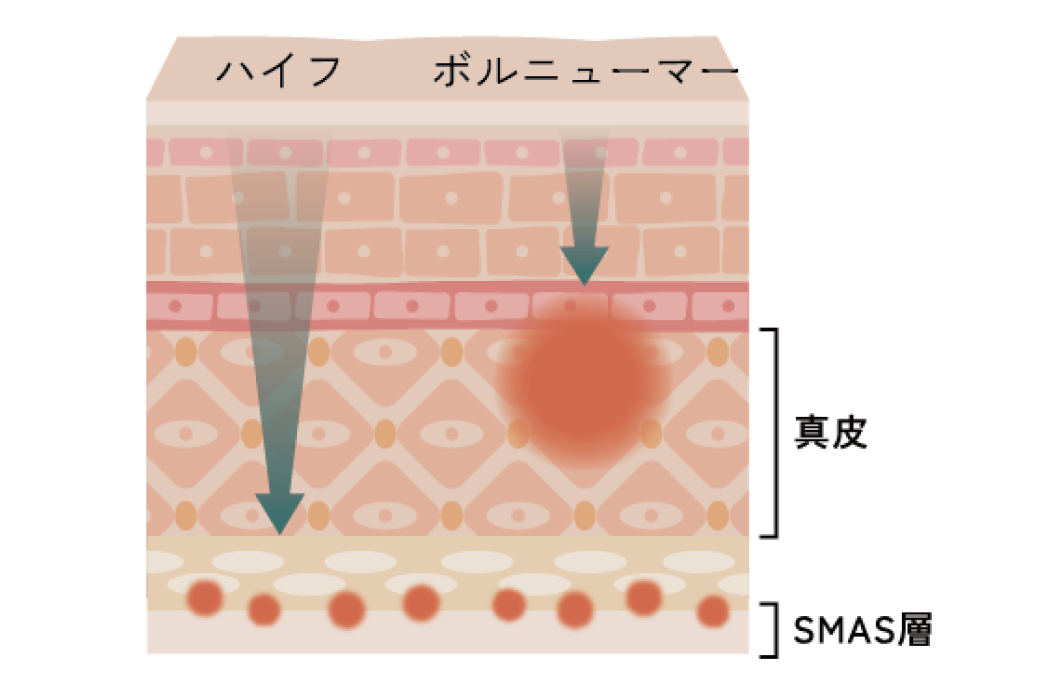 ハイフ ボルニューマー