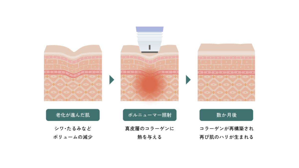 高周波・RF（ボルニューマー） | Menu | ALOOP CLINIC & LAB（美容皮膚 
