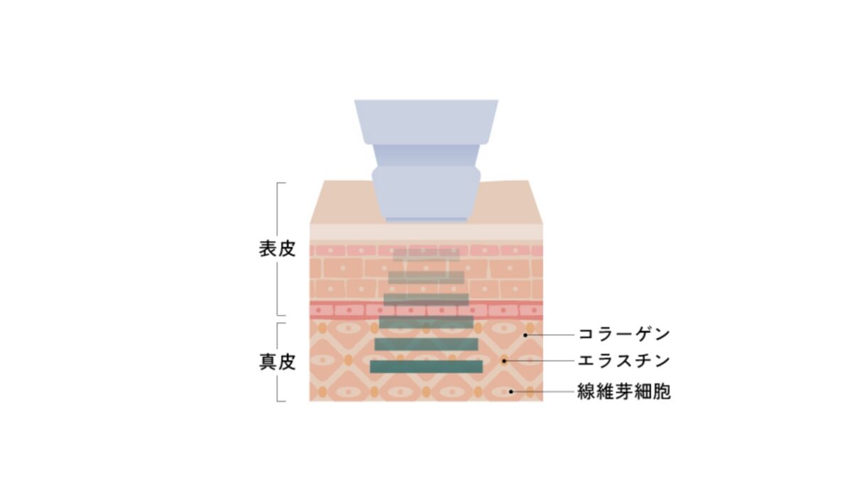 高周波・RF（ボルニューマー） | Menu | ALOOP CLINIC & LAB